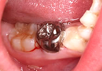2）乳歯冠